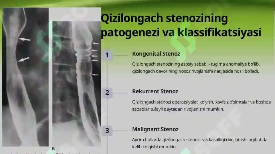 Qiziloʻngach stenozi va atreziyalarida operatsiya 8