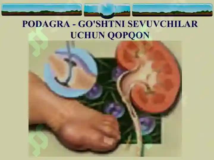 PODAGRA 2