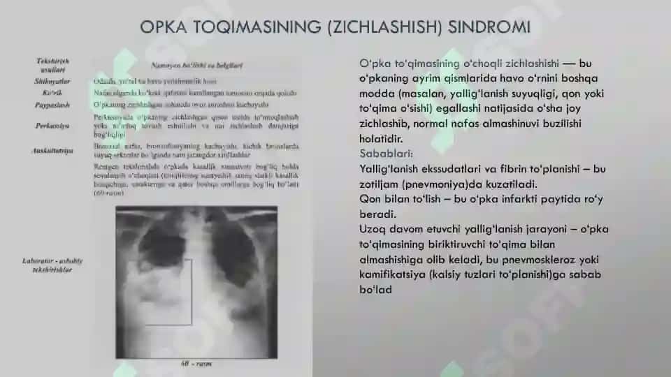 OPKA TOQIMASINING (ZICHLASHISH) SINDROMI 2