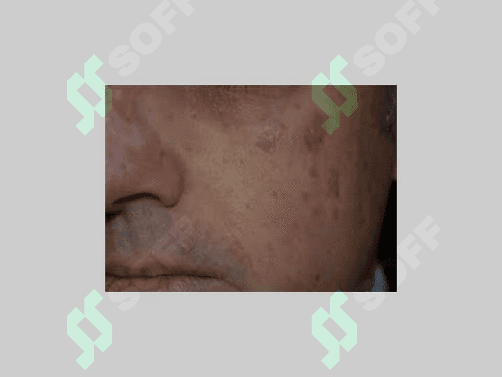 Terining xavfli o'smalari: Bazalioma,  yassi
           hujayrali rak va melanoma 8