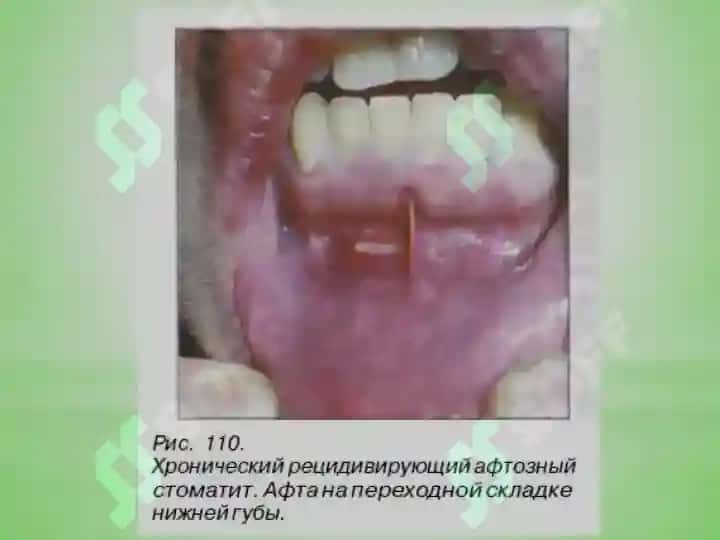 Surunkali aftoz stomatit. 8