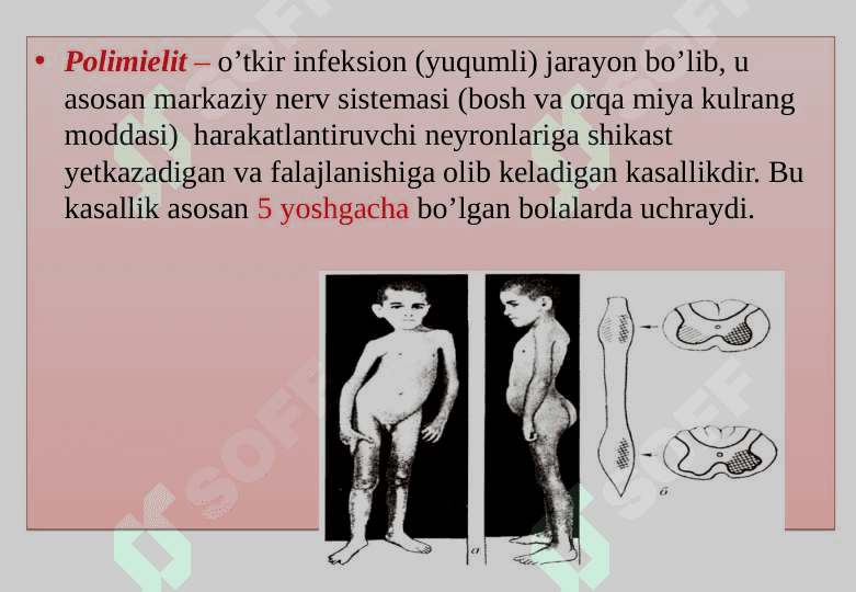 Polimielit kasalligining kelib chiqish sabablari va asoratlari 3