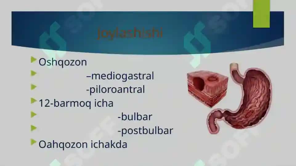 Meda ichak yara kasalligi 3
