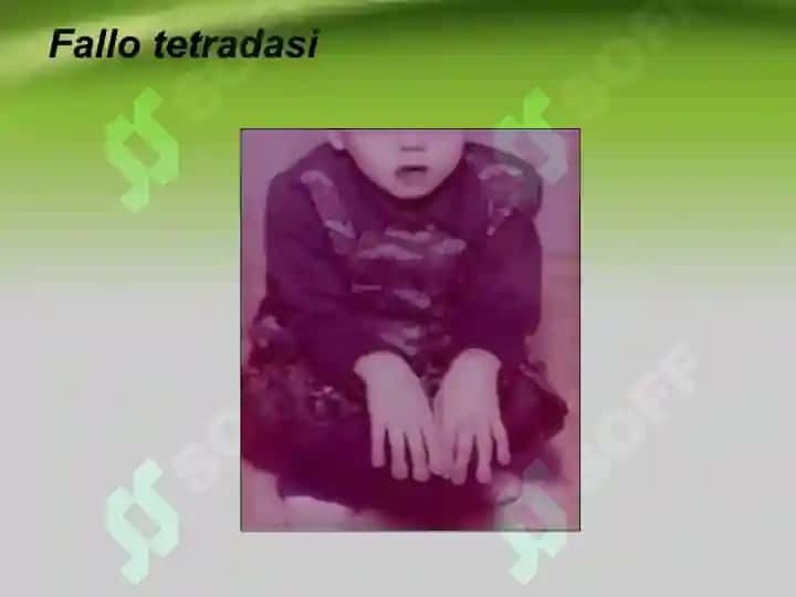 Yurak tug’ma nuqsonlari Юрак тугма нуксонлари 7