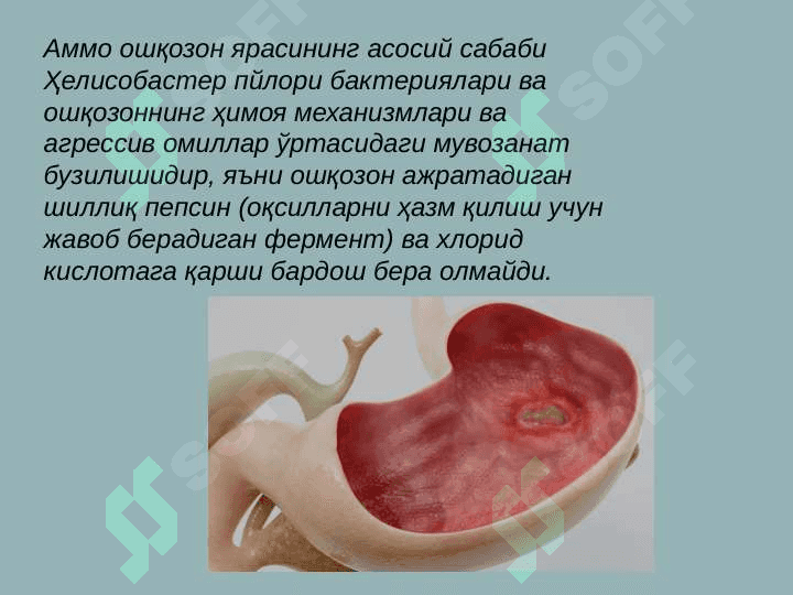 Oshqozon o'tkir yaralari va eroziyalari 3
