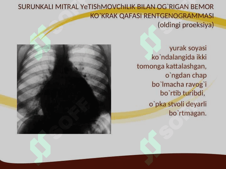 Mitral klapan prolapsi 8