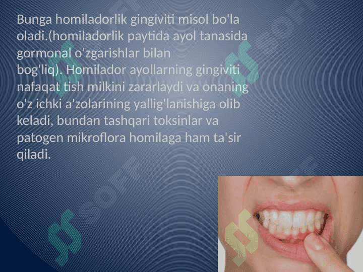 Homiladorlar gingiviti 3