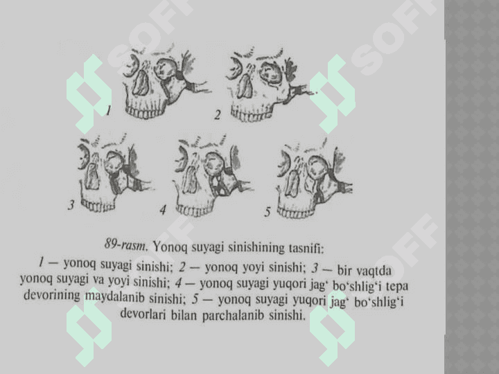 Yanoq yoyi va 
suyagini sinishi. 3