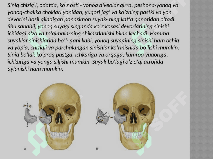 Yanoq yoyi va 
suyagini sinishi. 4