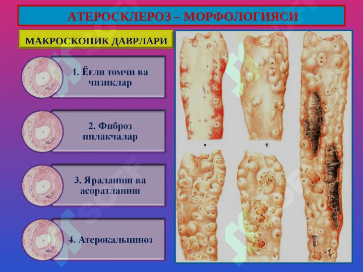 Атеросклероз. Гипертония касаллиги 6