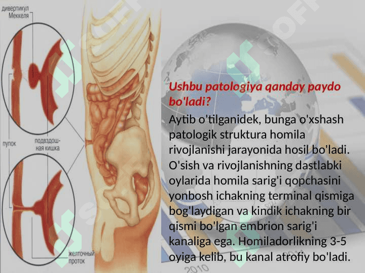 Mekkel divertikulini olib tashlash 5