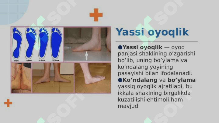 Oyoq panjasi statik deformatsiyasi 4