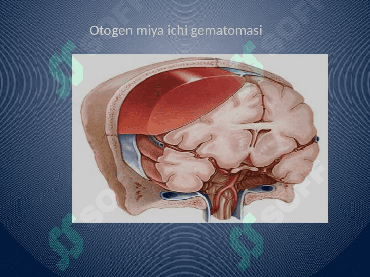 Otogen miya ichi gematomasida
 nevrologik simptomlar 5