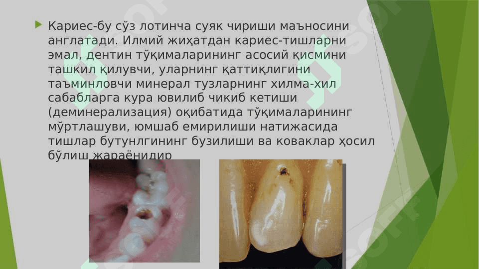 Dog’ bosqichidagi karies
 klinikasi tashxislash 2
