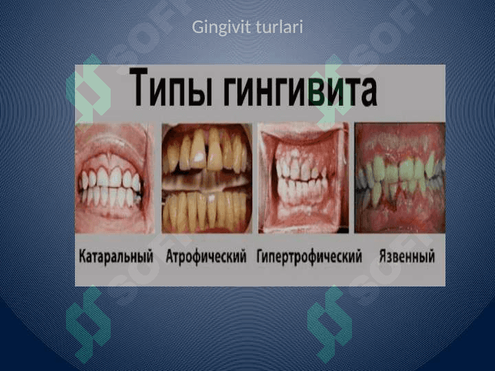 Gipertrofik gingivit 3