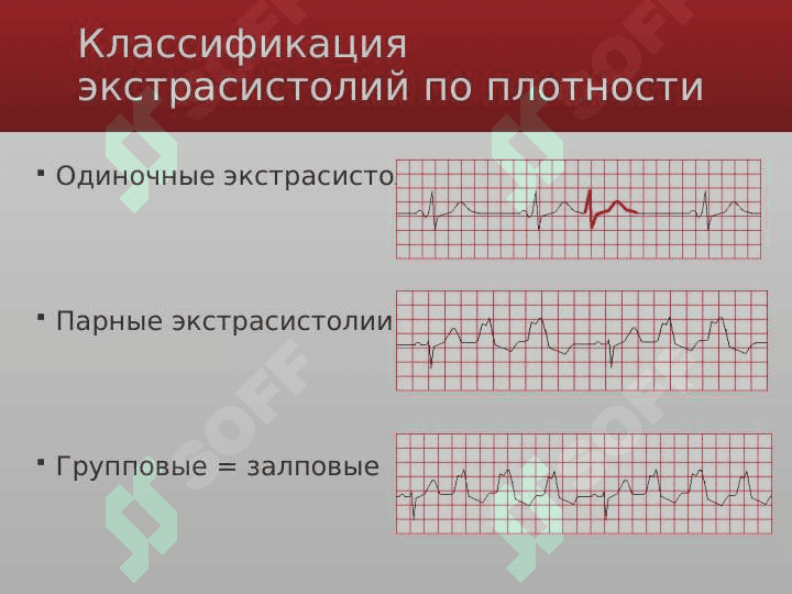 Ekstrosistoliya 5