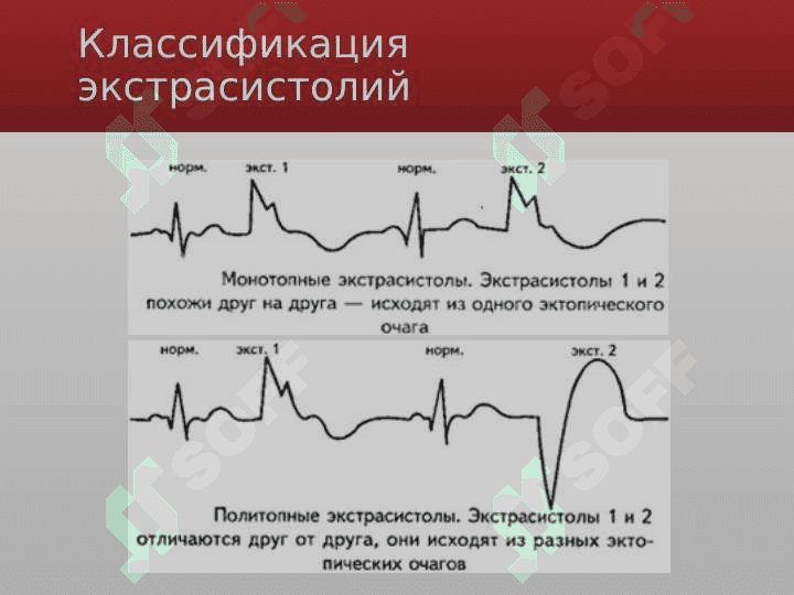Ekstrosistoliya 6