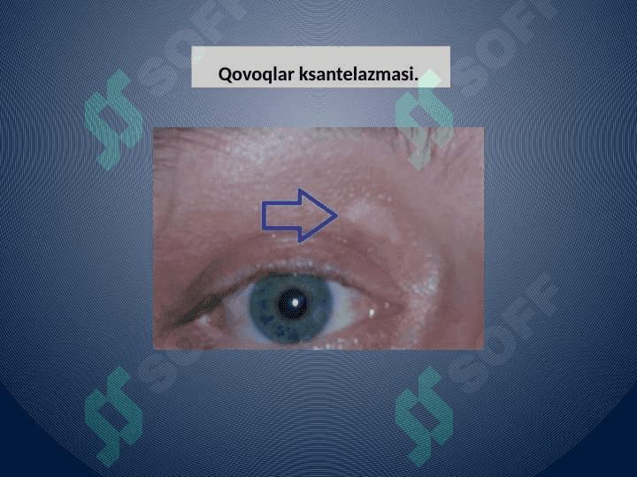 Ko’ruv azosini qon-tomir sistemasi kasalliklarida o’zgarishi 3