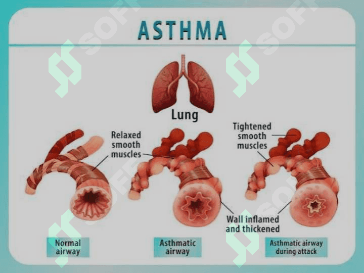 Bronxial astmaning zamonaviy tashxislash usullari (1)Bronxial astmaning zamonaviy tashxislash usullari (1) 2