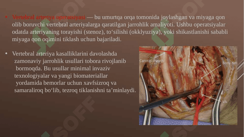 Vertebral arteriyada zamonaviy operatsiyalar 2