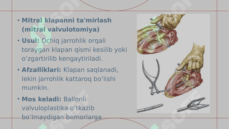 Mitral stenozda jarrohlik 3