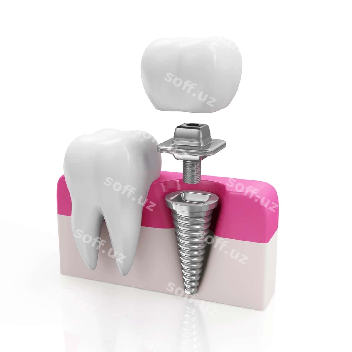 Sog'liq tish implanti | Health tooth dental implant 1