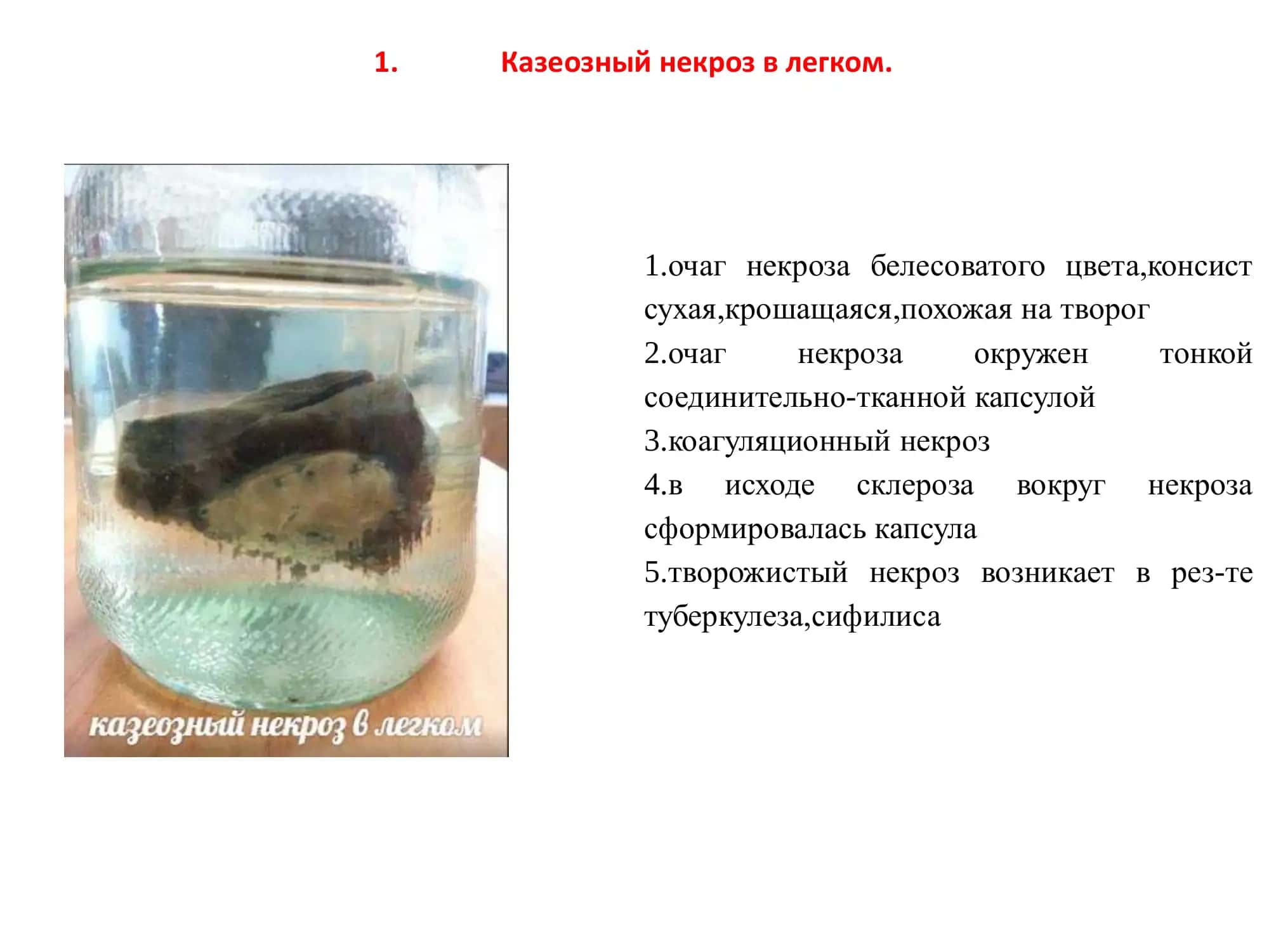 Казеозный некроз 1
