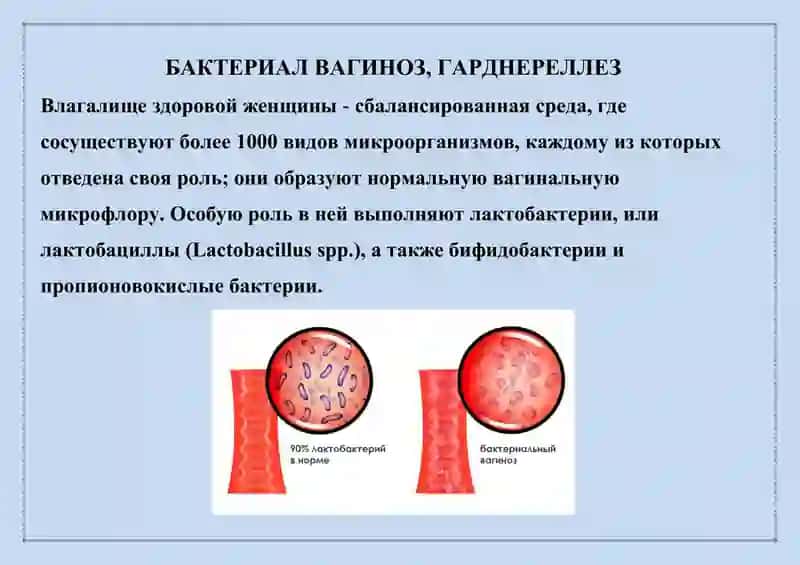 БАКТЕРИАЛ ВАГИНОЗ, ГАРДНЕРЕЛЛЕЗ