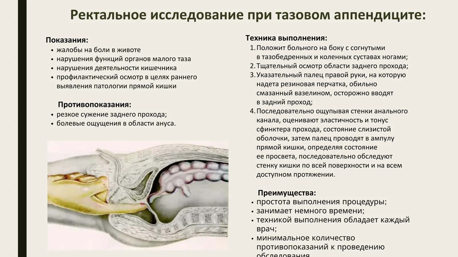 Ректальное исследование при тазовом аппендиците 1