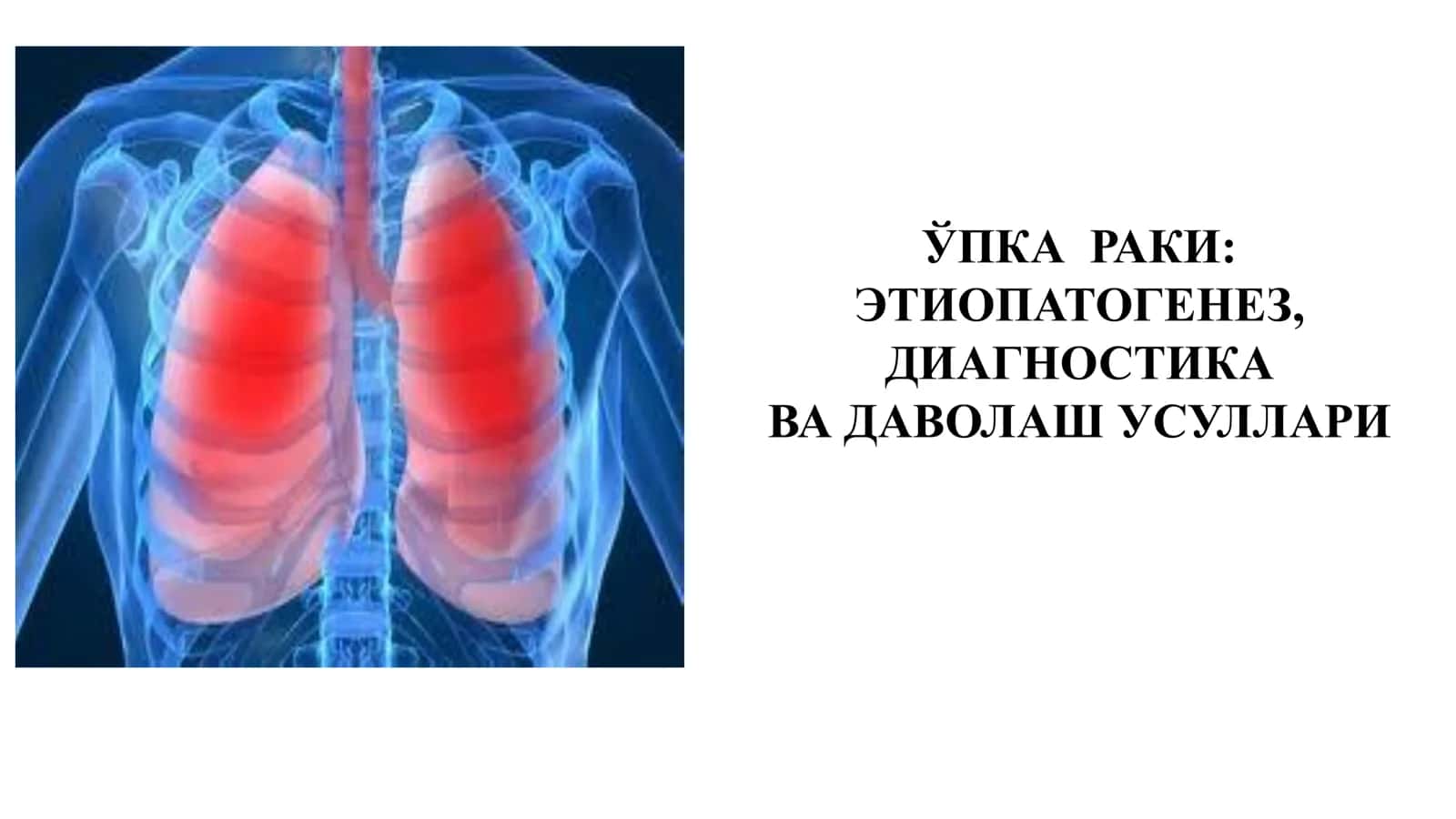 ЎПКА РАКИ: ЭТИОПАТОГЕНЕЗ, ДИАГНОСТИКА ВА ДАВОЛАШ УСУЛЛАРИ 1