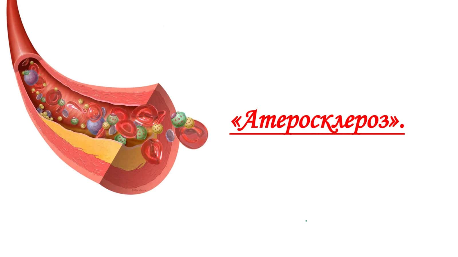 Атеросклероз 1