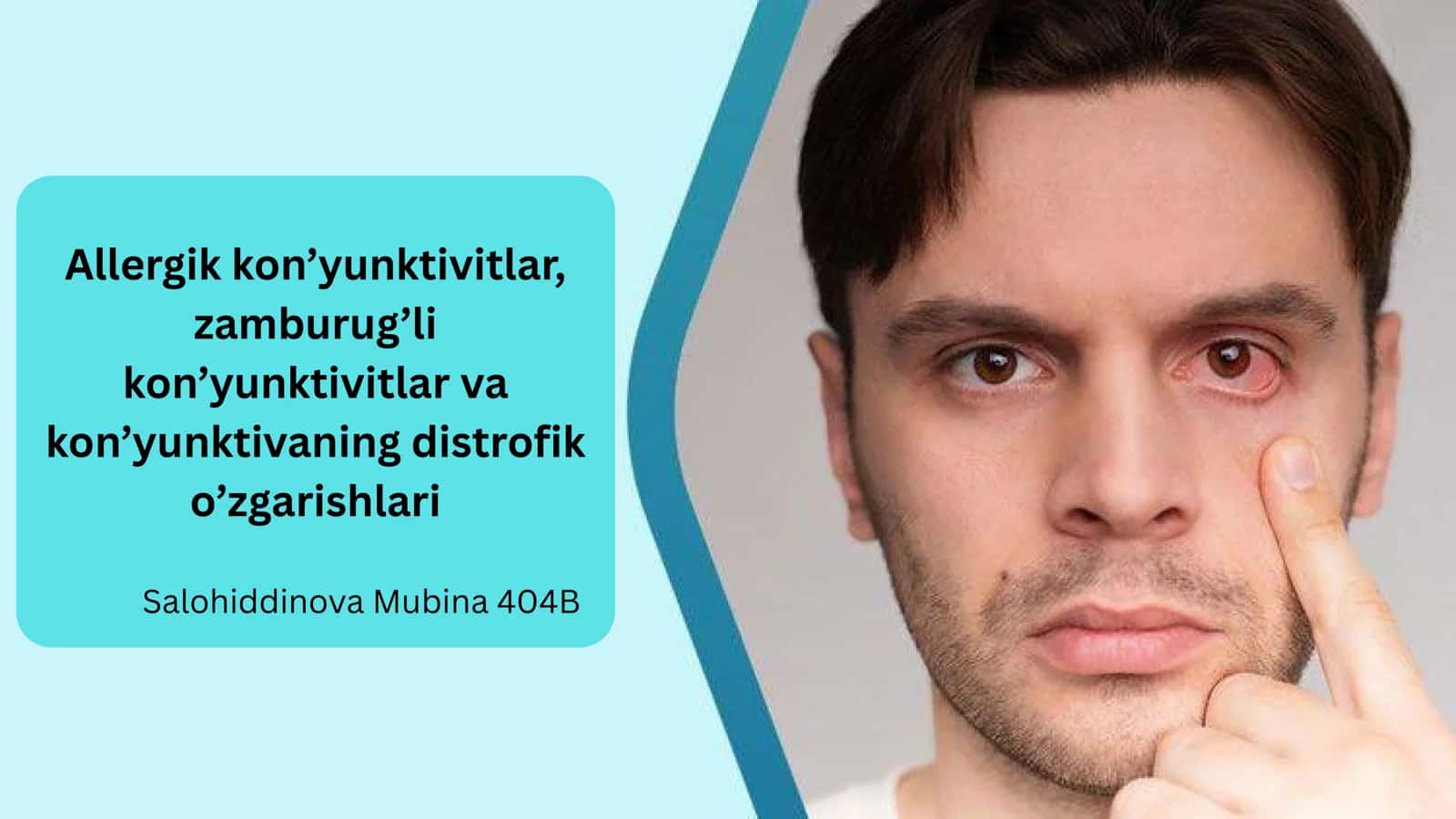 Allergik kon’yunktivitlar 1