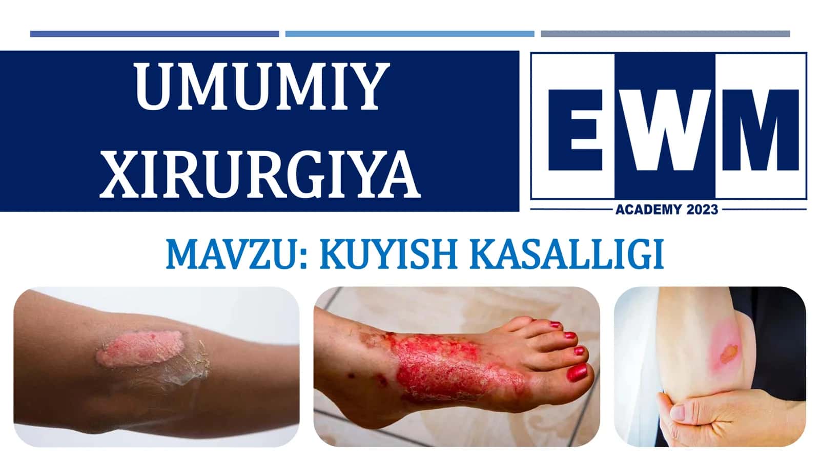 KUYISH KASALLIGI 2