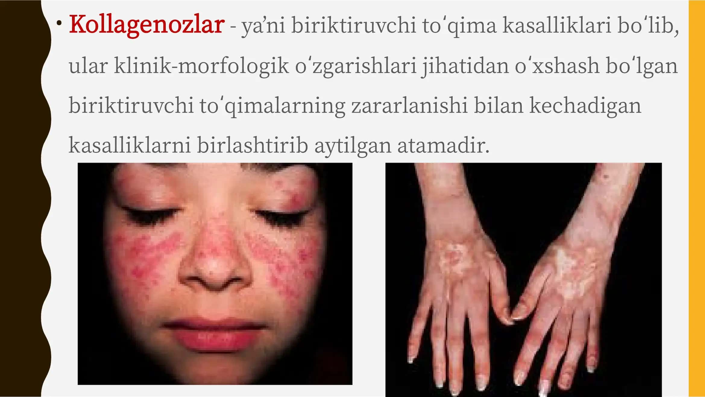 Kollagenoz, patogenezi, tashxisi 2