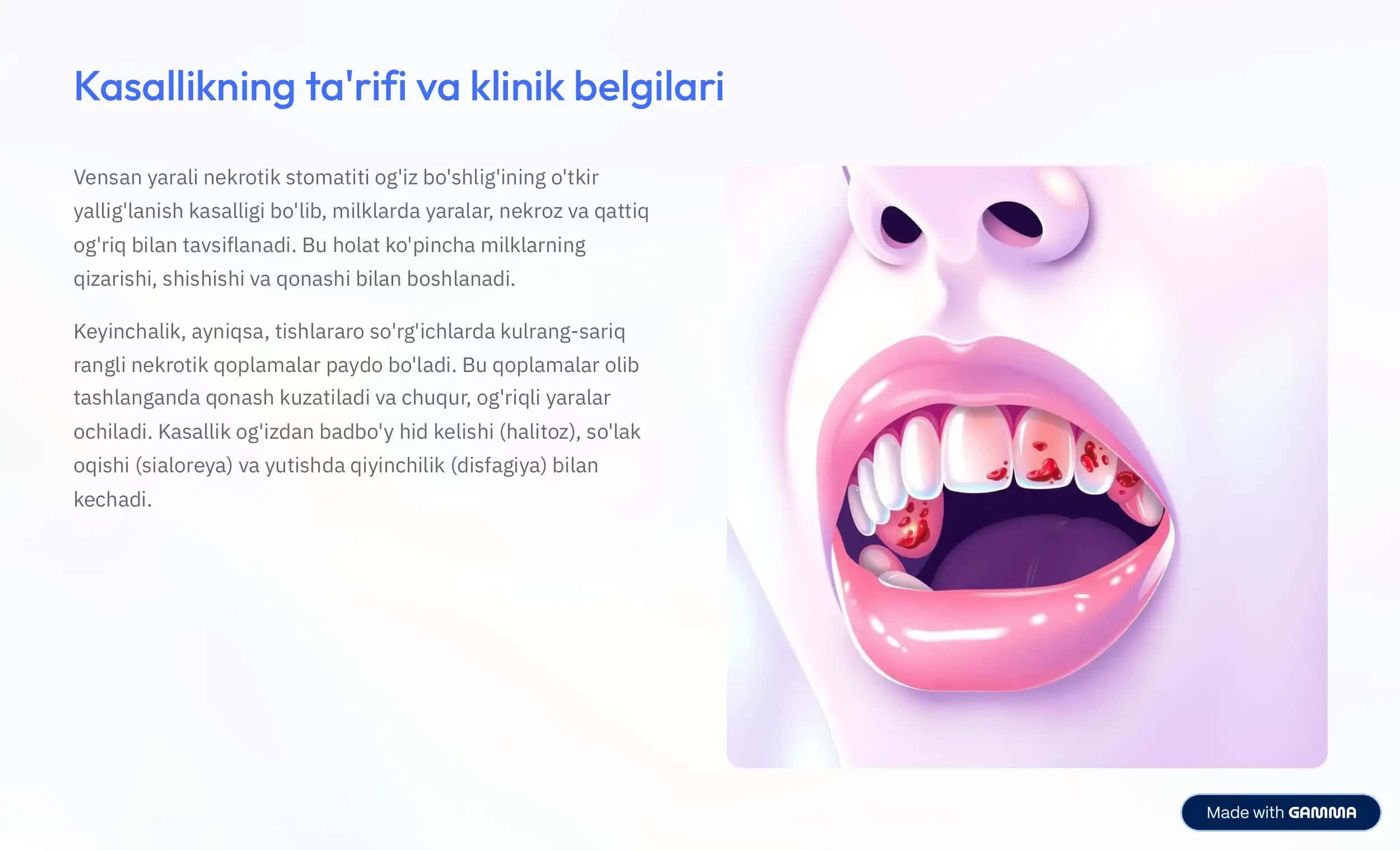 Vensan yarali nekrotik stomatiti 2