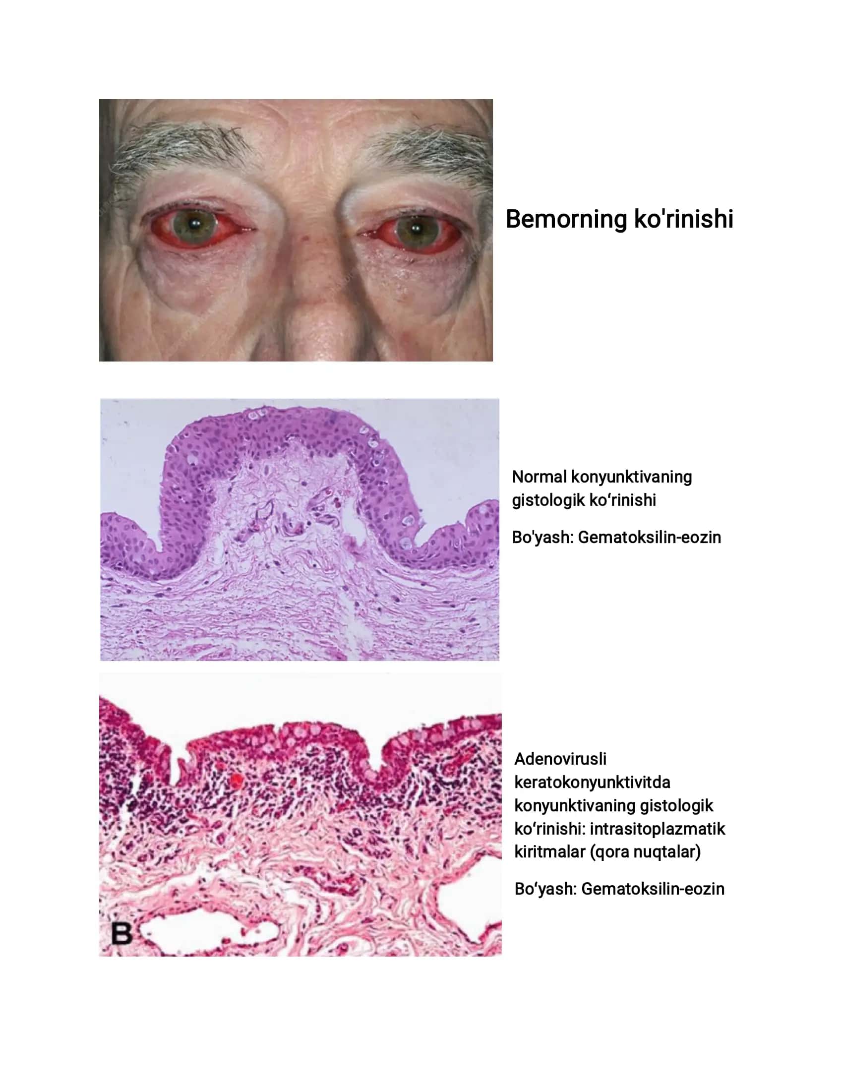 Klinik keys Gistologiya Virusli keratokonyunktivit 2