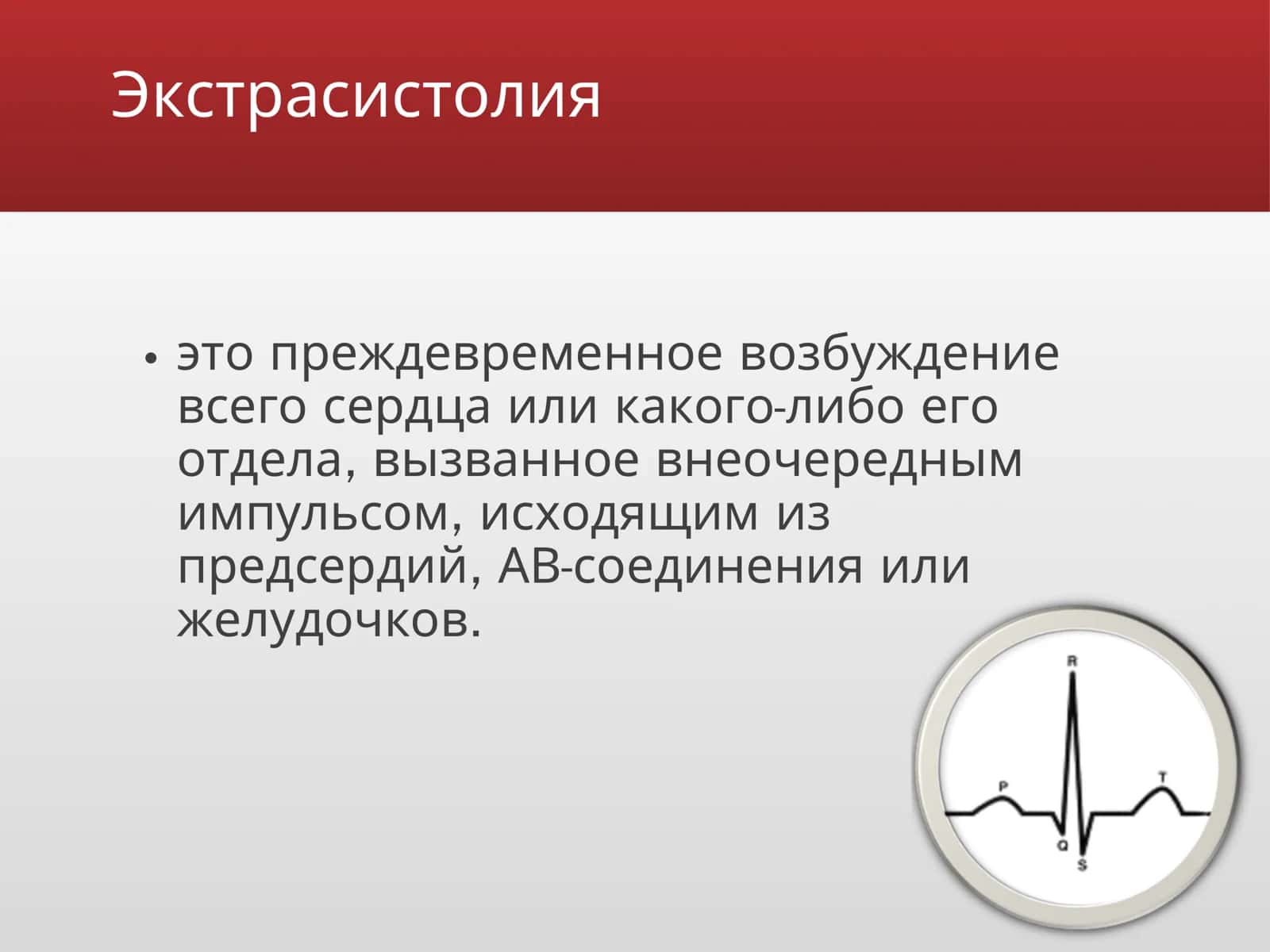 Экстрасистолии 2
