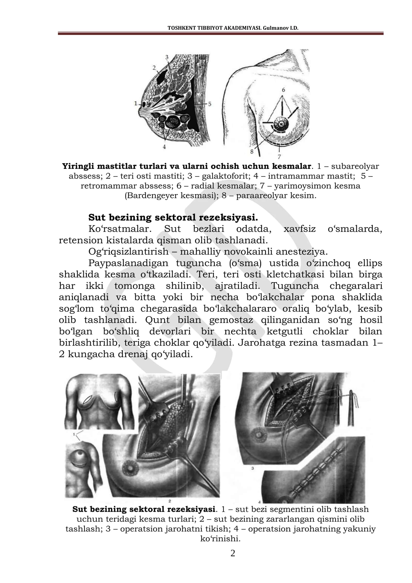 Sut bezlari kasalliklaridagi operatsiyalar 2