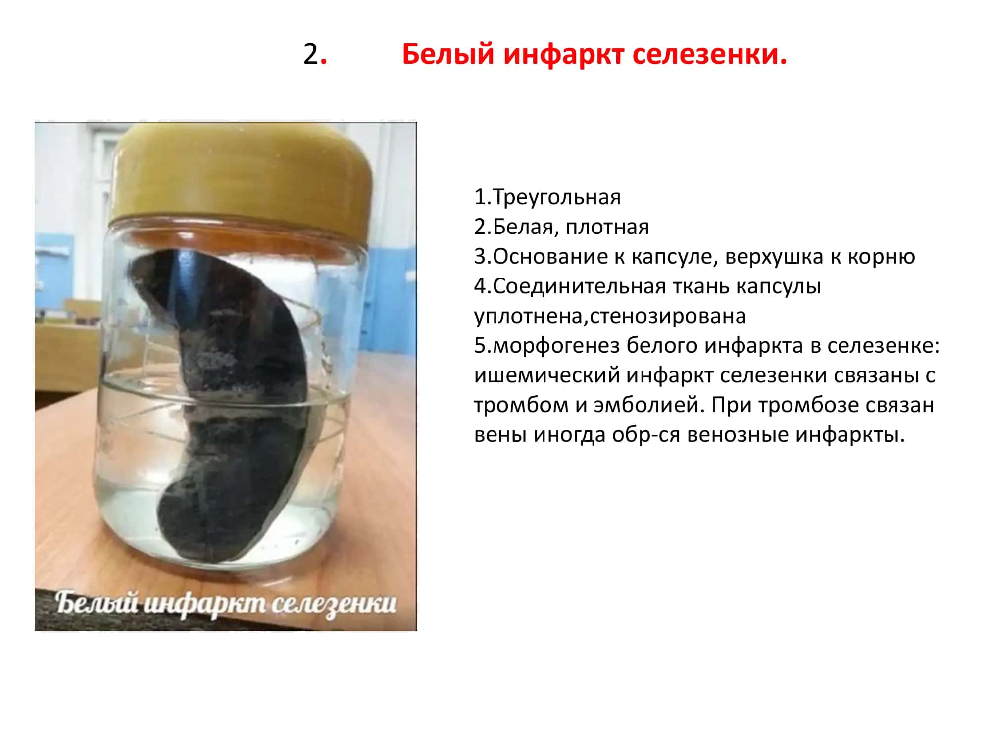 Казеозный некроз 2