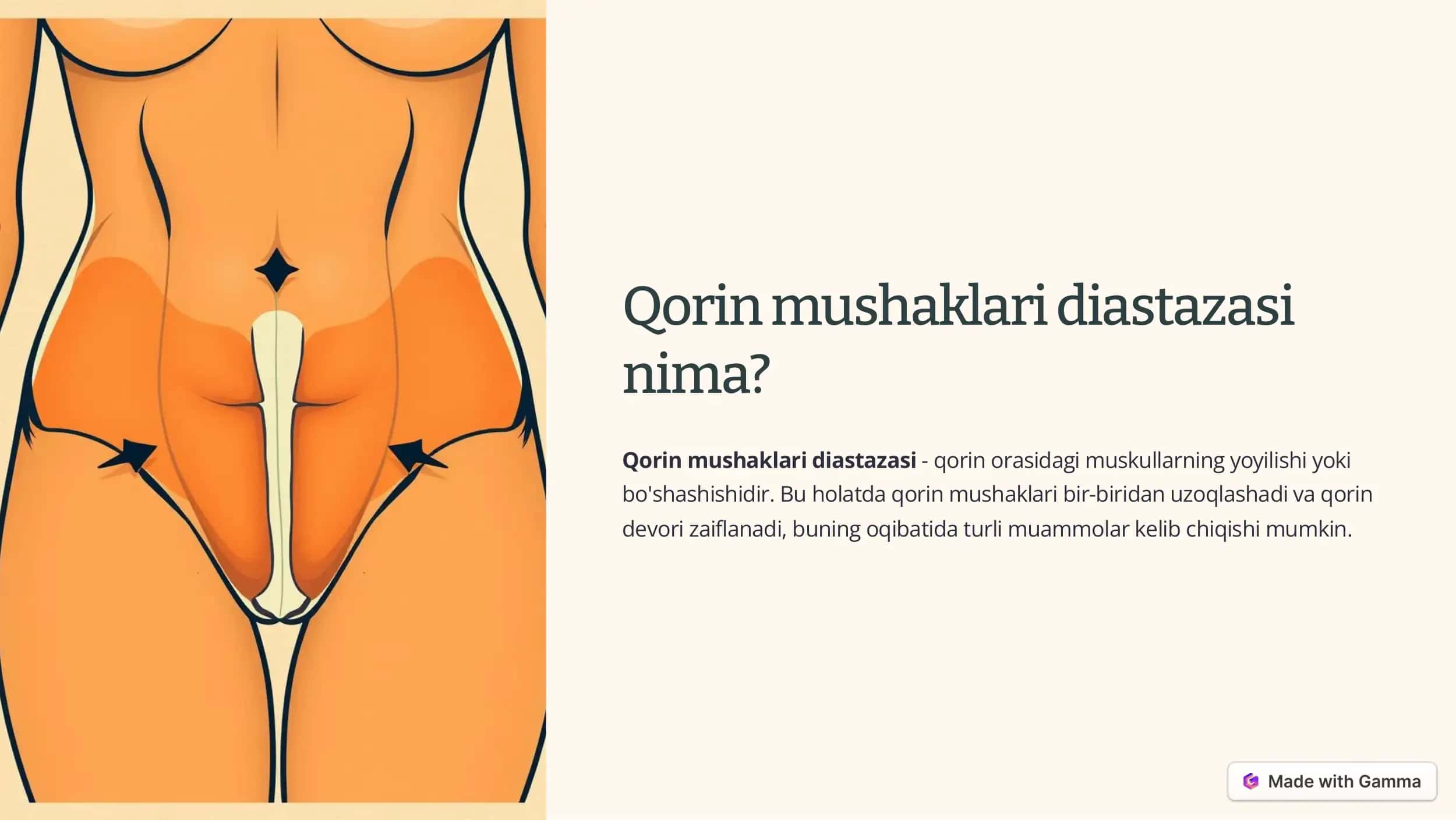 Qorin mushaklari diastazasi 2