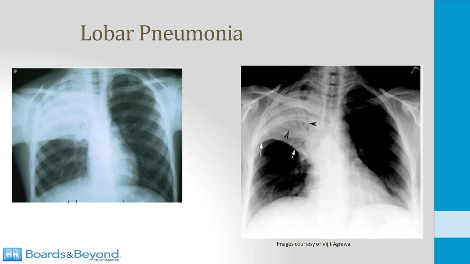 Lobar Pneumonia 3
