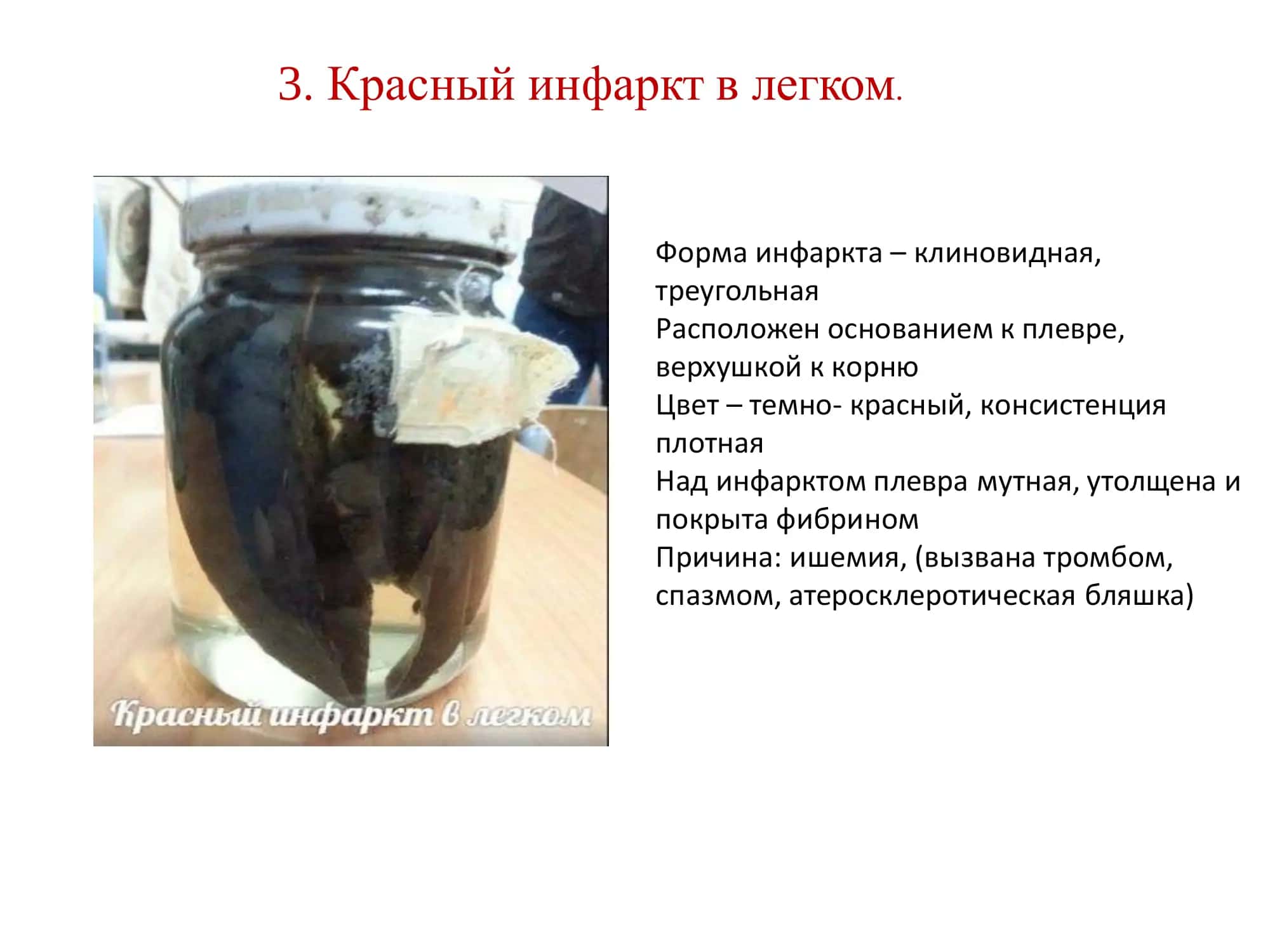 Казеозный некроз 3