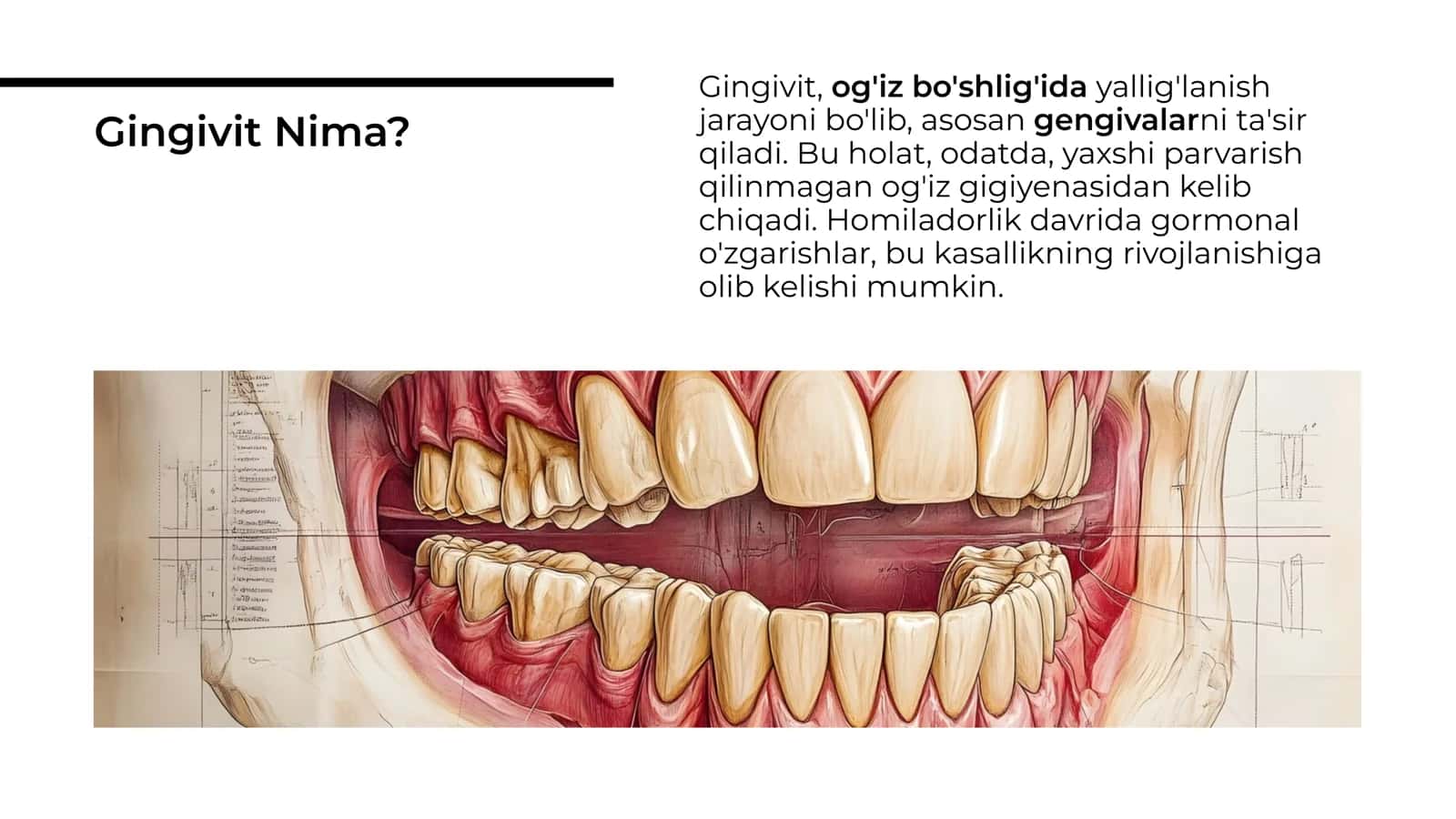 Homiladorlikda gingivit 3