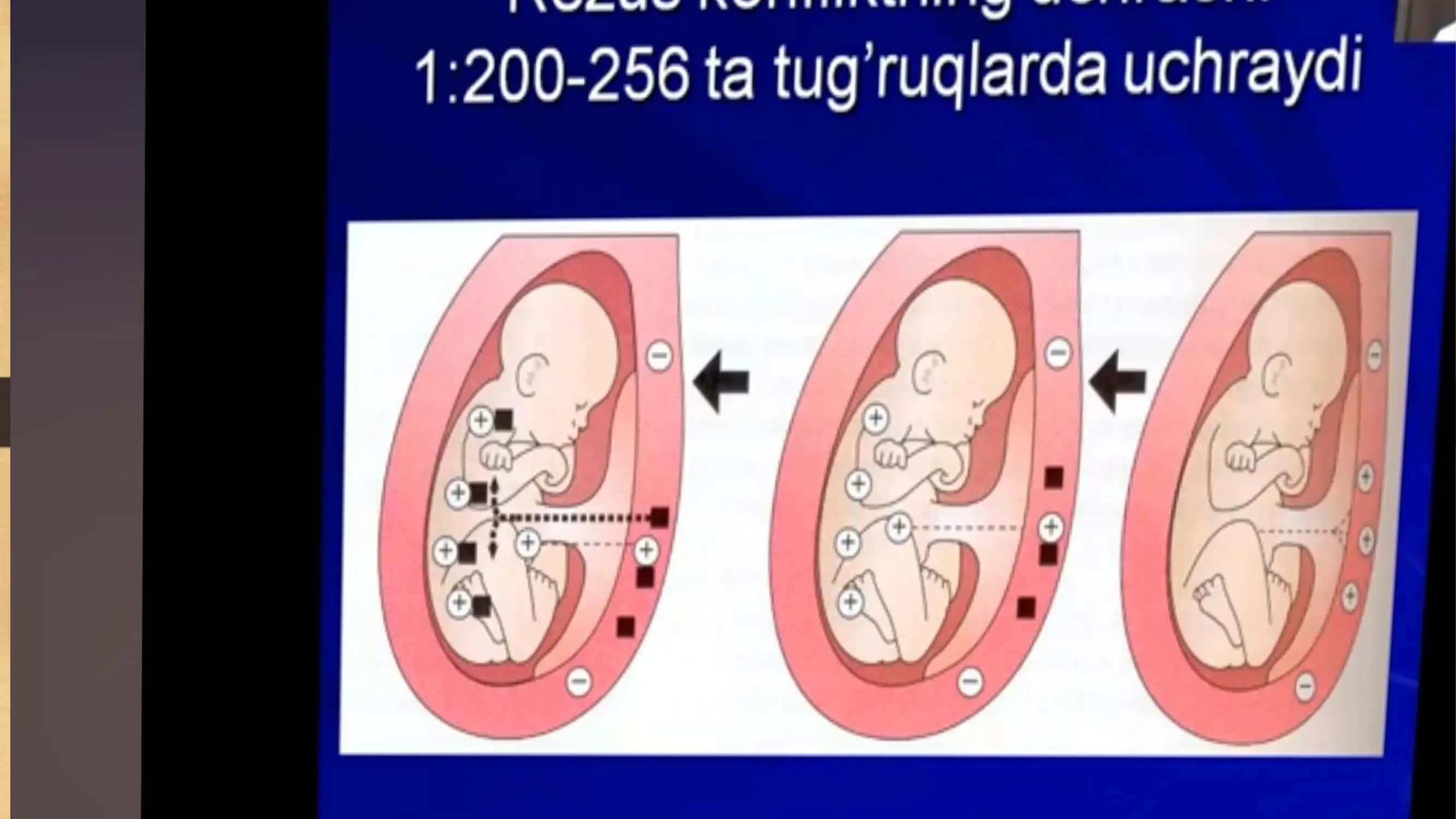 Chaqaloqlarda gemoletik kasalliklar 3