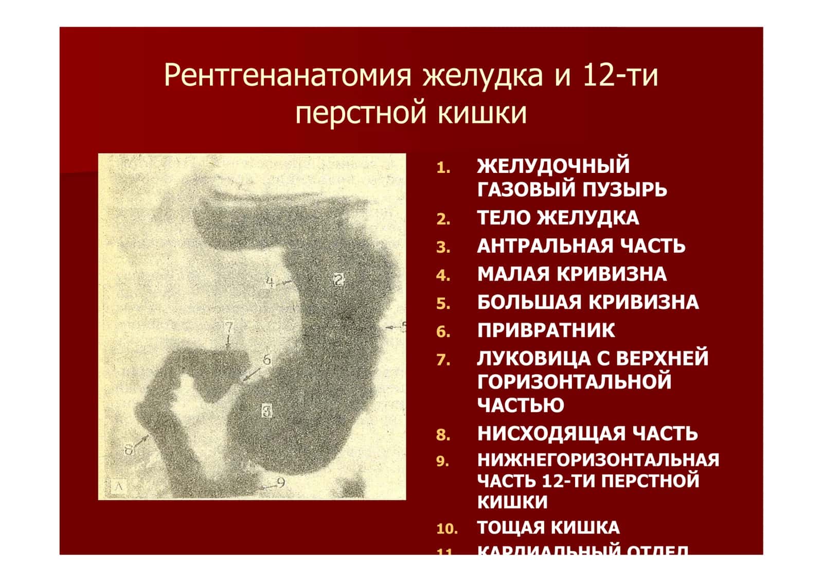 Рентгенодиагностика язвенной болезни 3