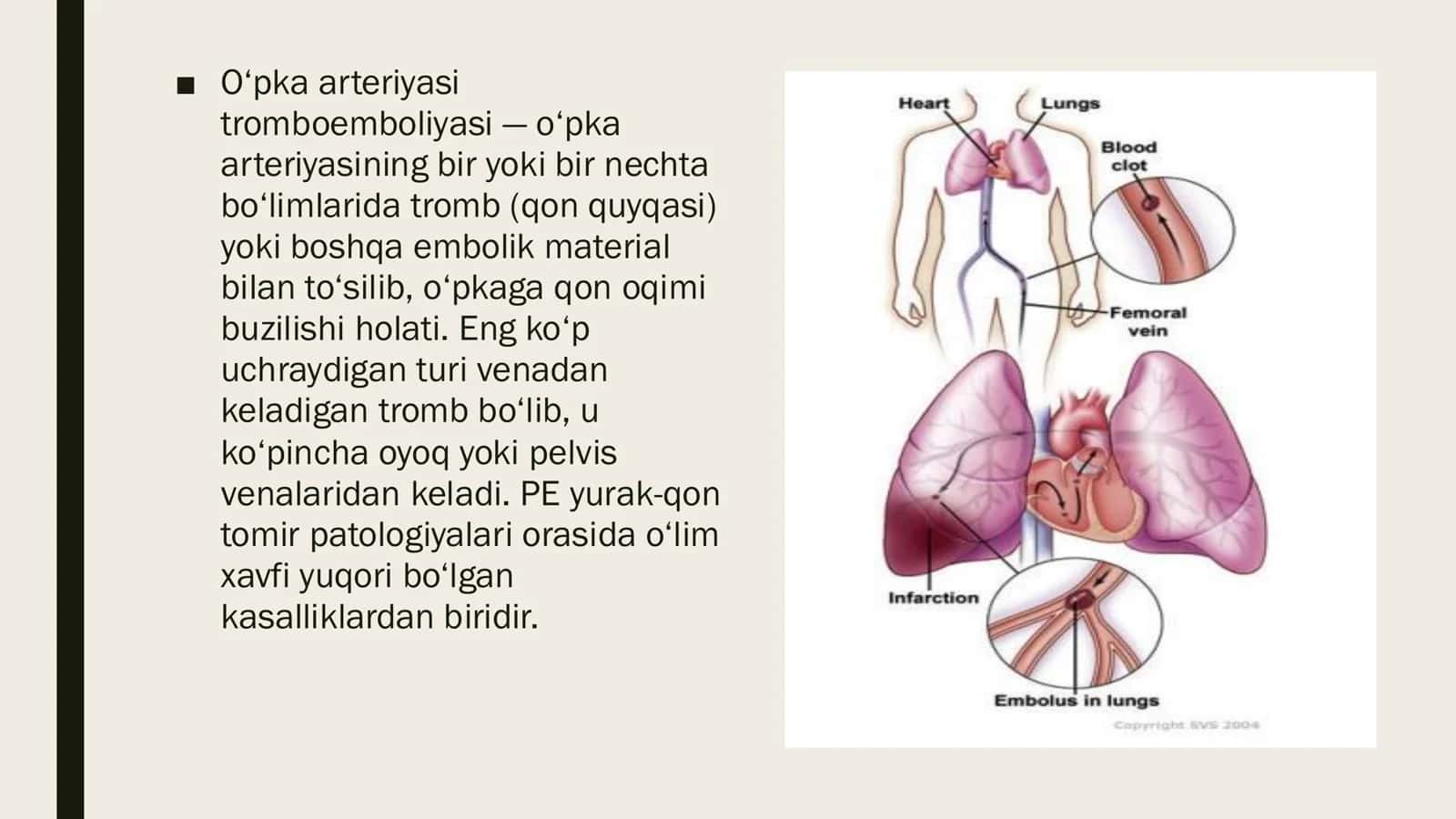 OʻPKA ARTERIYASI TROMBOEMBOLIYASI 3