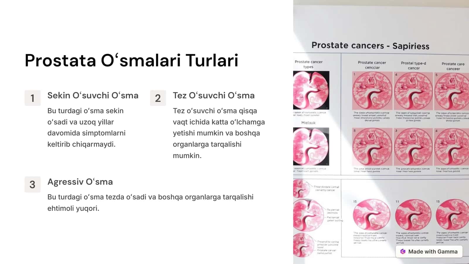 Prostata Bezi Oʻsmalari 3