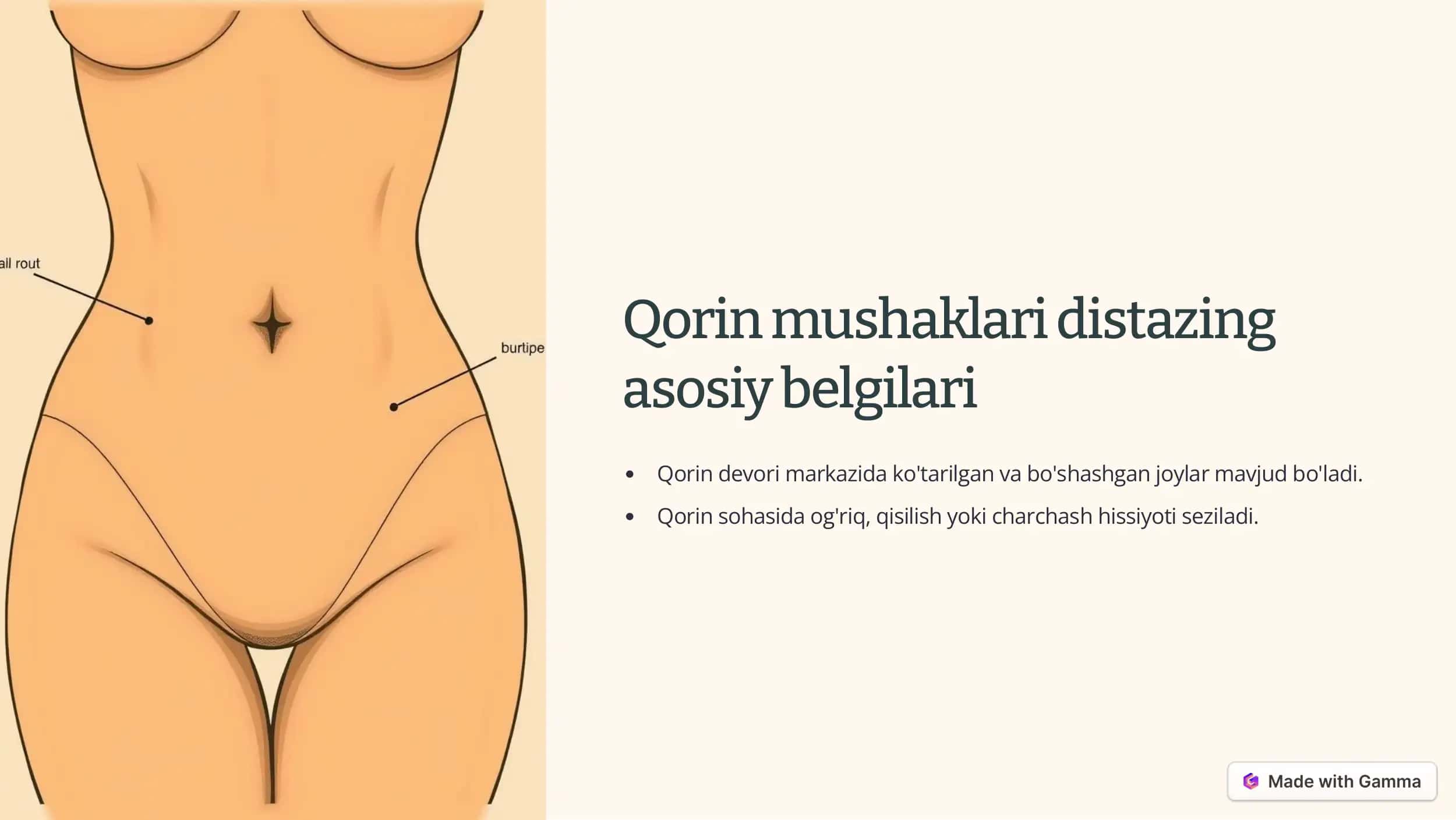 Qorin mushaklari diastazasi 3