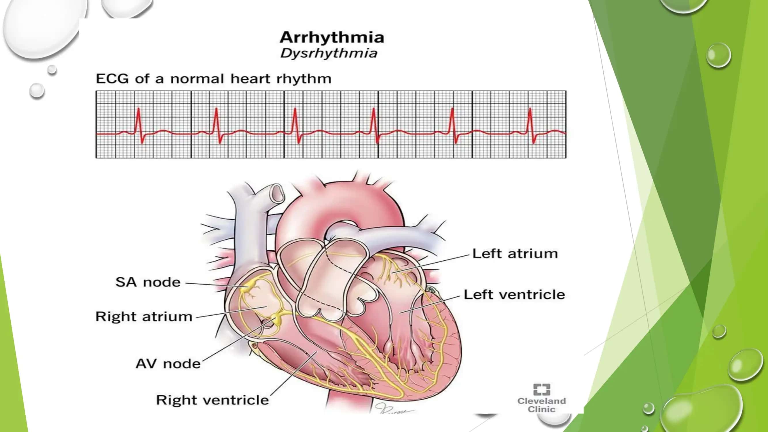 Yurak aritmiyalari EKG diagnostikasi 3