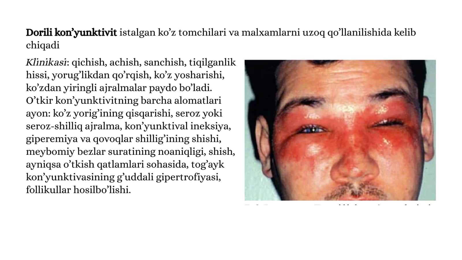 Allergik kon’yunktivitlar 3